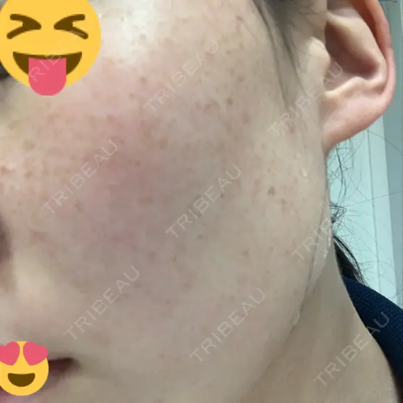 美肌レーザー / シミ取りレーザー たかはし形成外科･美容外科  DAY 11 メイン用