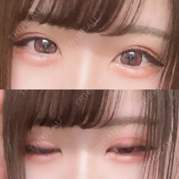 二重埋没 / ヒアルロン酸注入（涙袋） ルラ美容クリニック 新宿院 AFTER メイン用