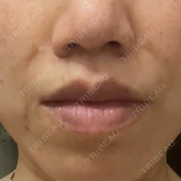 人中短縮 銀座アテナクリニック DAY 250 メイン用