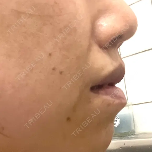 人中短縮 銀座アテナクリニック DAY 250 メイン用