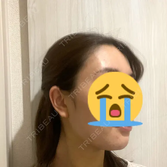 脂肪吸引（顔） ヴェルトラクリニック 大阪院 DAY 3 メイン用