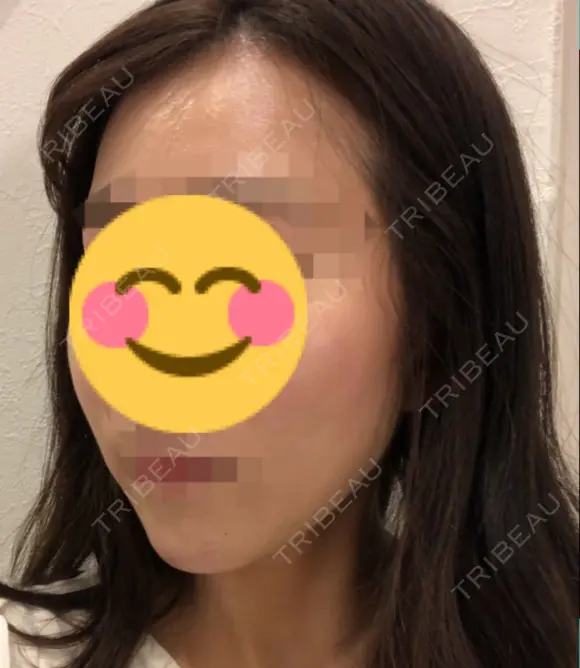 脂肪注入（輪郭） 湘南美容クリニック 新潟院 DAY 18 メイン用