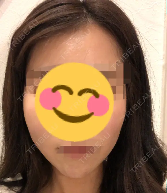 脂肪注入（輪郭） 湘南美容クリニック 新潟院 DAY 18 メイン用