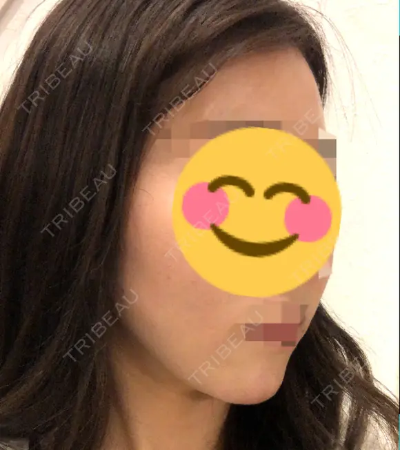 脂肪注入（輪郭） 湘南美容クリニック 新潟院 DAY 18 メイン用