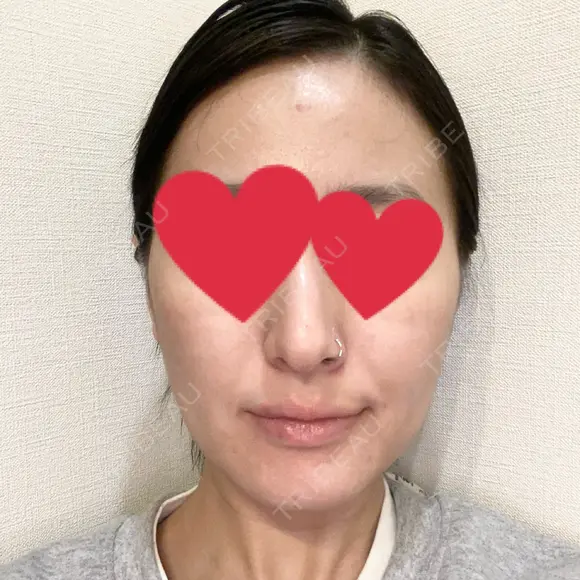 ハイフ（顔） 池袋麗歯科・美容皮膚科 DAY 0 メイン用