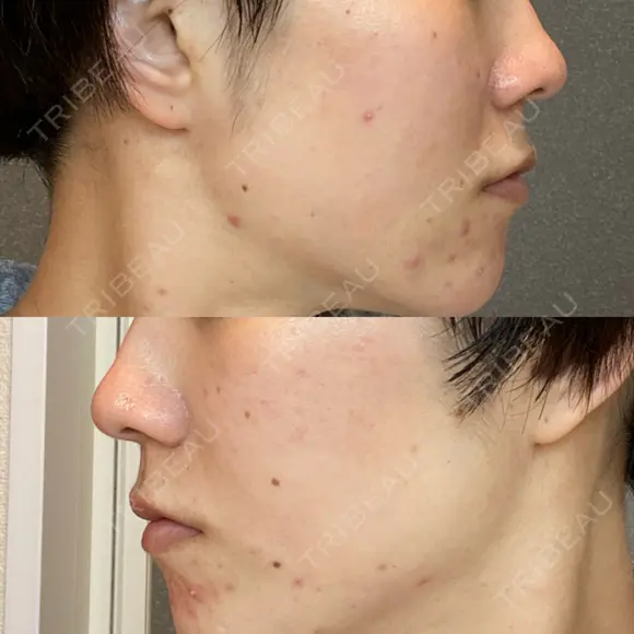 ダーマペン AURORA CLINIC（オーロラクリニック）新宿院 AFTER メイン用