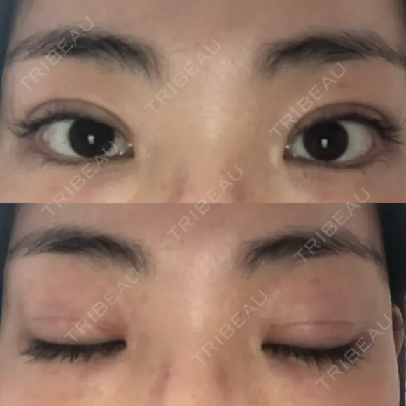 二重切開 松下皮フ形成外科 DAY 31 メイン用