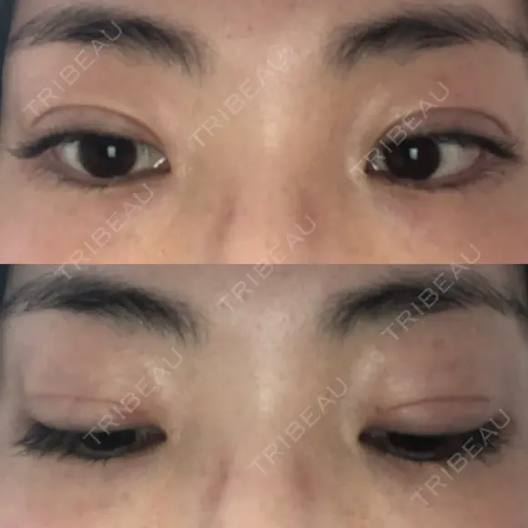 二重切開 松下皮フ形成外科 DAY 31 メイン用