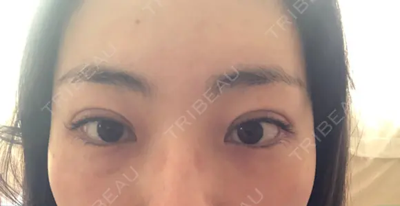 二重切開 松下皮フ形成外科 DAY 31 メイン用