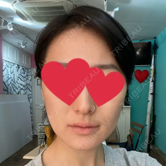 ハイフ（顔） 池袋麗歯科・美容皮膚科 DAY 1 メイン用