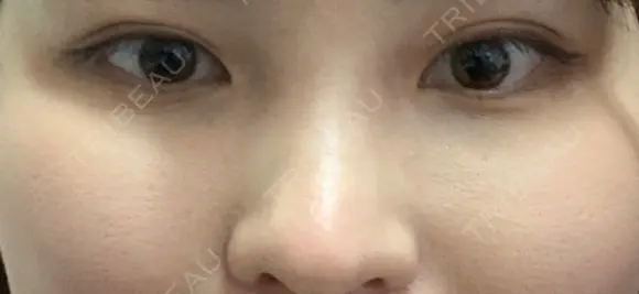 下まぶたの脂肪取り 品川美容外科 仙台院 AFTER メイン用