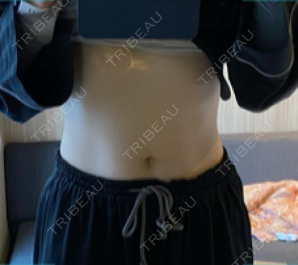 GLP-1ダイエット 湘南美容クリニック 横須賀中央院 DAY 7 メイン用