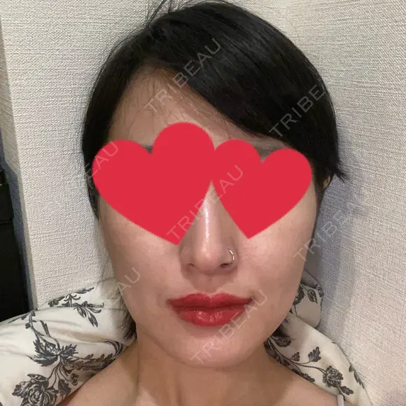 ハイフ（顔） 池袋麗歯科・美容皮膚科 DAY 2 メイン用