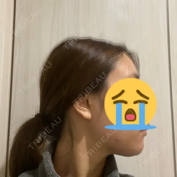 脂肪吸引（顔） ヴェルトラクリニック 大阪院 DAY 7 メイン用