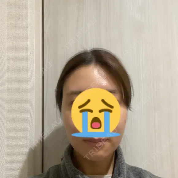 脂肪吸引（顔） ヴェルトラクリニック 大阪院 DAY 7 メイン用