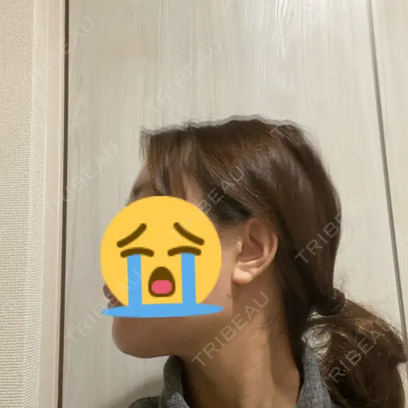 脂肪吸引（顔） ヴェルトラクリニック 大阪院 DAY 7 メイン用