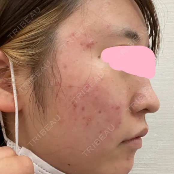 シミ取りレーザー UB CLINIC銀座 DAY 1 メイン用