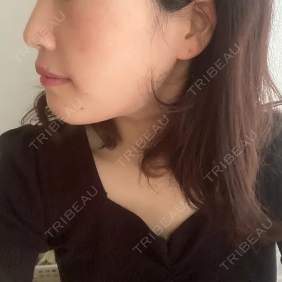 セットバック カトレア歯科・美容クリニック DAY 20 メイン用