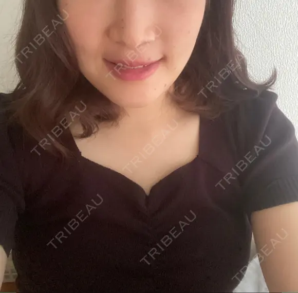 セットバック カトレア歯科・美容クリニック DAY 20 メイン用