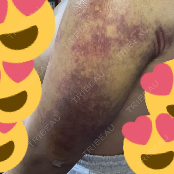 脂肪吸引（二の腕） 湘南美容クリニック 新潟院 DAY 10 メイン用