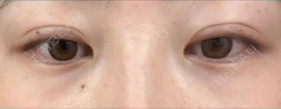二重埋没 リオラビューティークリニック 柏院 DAY 16 メイン用