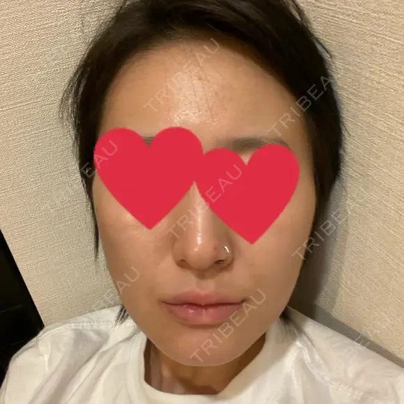 ハイフ（顔） 池袋麗歯科・美容皮膚科 DAY 5 メイン用