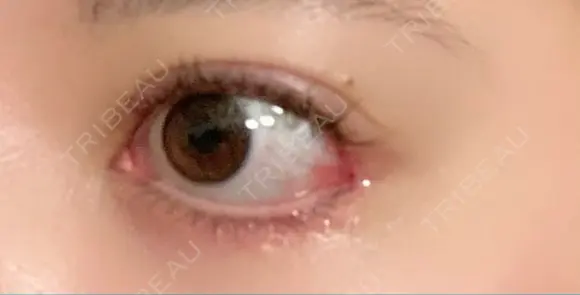 目尻靭帯移動 こいずみ形成クリニック名古屋 DAY 12 メイン用