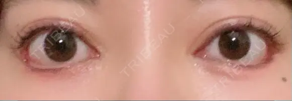 目尻靭帯移動 こいずみ形成クリニック名古屋 DAY 12 メイン用