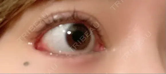 目尻靭帯移動 こいずみ形成クリニック名古屋 DAY 12 メイン用