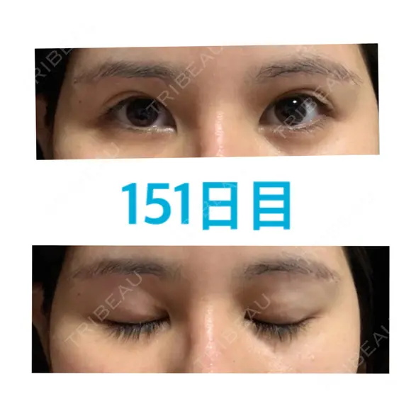 上まぶたの脂肪取り / 眉下切開 JUN CLINIC DAY 151 メイン用