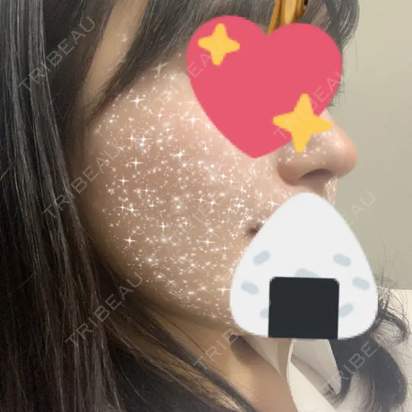 鼻尖形成（切開） / 鼻中隔延長（切開） / 軟骨移植 / その他（鼻） KAUNIS CLINIC（カウニスクリニック） DAY 36 メイン用