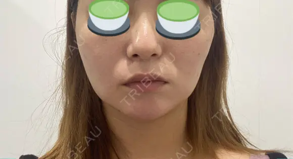 糸リフト 表参道スキンクリニック 表参道院 DAY 5 メイン用