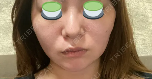 糸リフト 表参道スキンクリニック 表参道院 DAY 6 メイン用