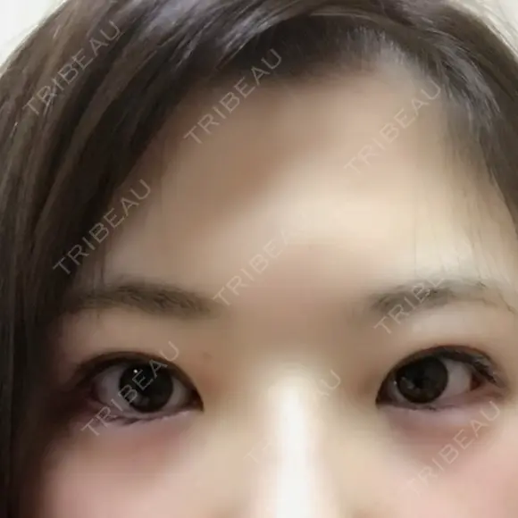 二重切開 / 眼瞼下垂（切開） / 目尻切開 ジュエリー美容外科 AFTER メイン用