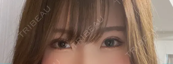 二重切開 / 上まぶたの脂肪取り 松下皮フ形成外科 DAY 31 メイン用