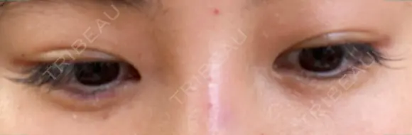 ヒアルロン酸注入（涙袋） 新宿ビューティークリニック 新宿院 DAY 2 メイン用