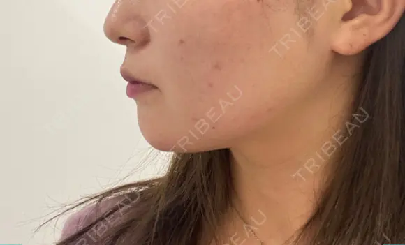 糸リフト 表参道スキンクリニック 表参道院 DAY 8 メイン用