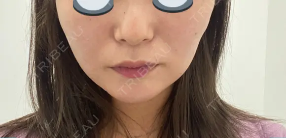 糸リフト 表参道スキンクリニック 表参道院 DAY 8 メイン用