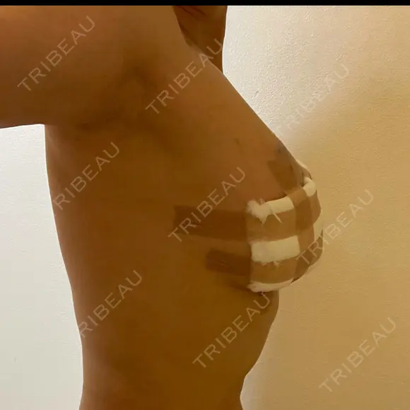 豊胸（脂肪注入） 石倉クリニック 水戸院 DAY 107 メイン用