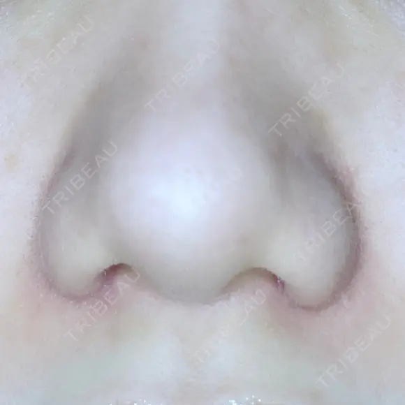 小鼻縮小（切開） ながしまクリニック DAY 28 メイン用