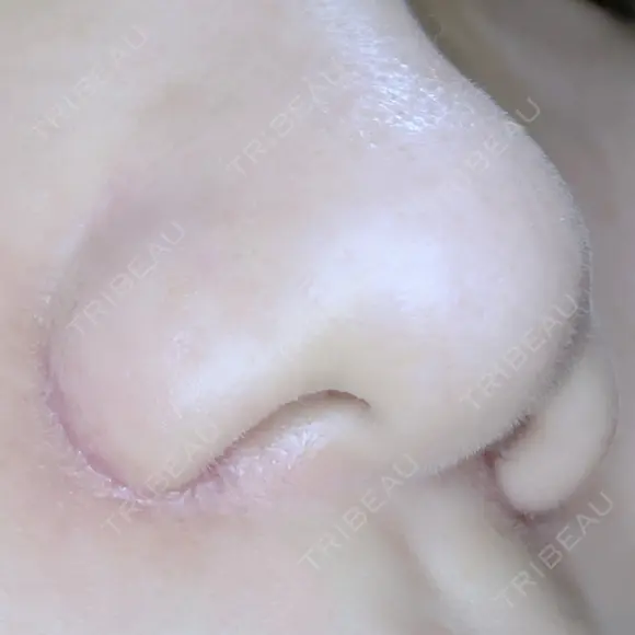 小鼻縮小（切開） ながしまクリニック DAY 28 メイン用