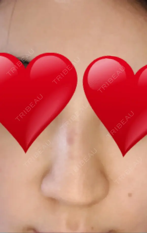 ヒアルロン酸注入（鼻） 新宿ビューティークリニック 新宿院 DAY 3 メイン用