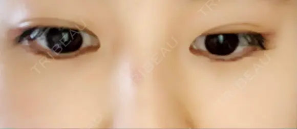 ヒアルロン酸注入（涙袋） 新宿ビューティークリニック 新宿院 DAY 3 メイン用