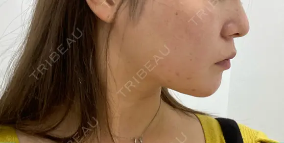 糸リフト 表参道スキンクリニック 表参道院 DAY 9 メイン用