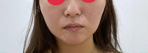 糸リフト 表参道スキンクリニック 表参道院 DAY 9 メイン用