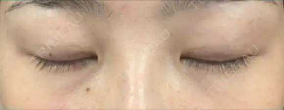 二重埋没 リオラビューティークリニック 柏院 DAY 25 メイン用