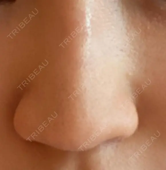 ヒアルロン酸注入（鼻） 新宿ビューティークリニック 新宿院 DAY 4 メイン用