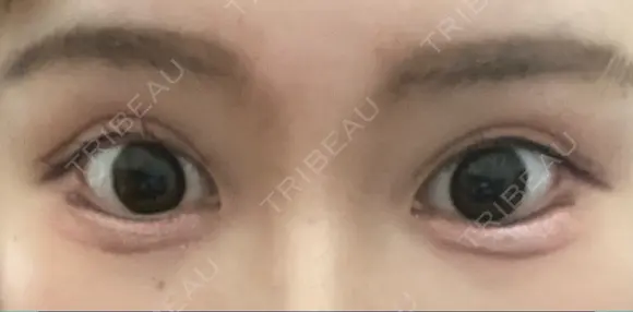 目尻切開 / タレ目形成・グラマラスライン（切開） ビスポーククリニック 福岡院 DAY 84 メイン用