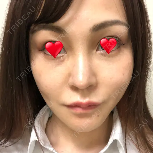 隆鼻術 / 鼻尖形成（切開） / 鼻中隔延長（切開） / 軟骨移植 / プロテーゼ除去 / 鼻修正 THE ROPPONGI CLINIC（ザ 六本木クリニック） DAY 49 メイン用