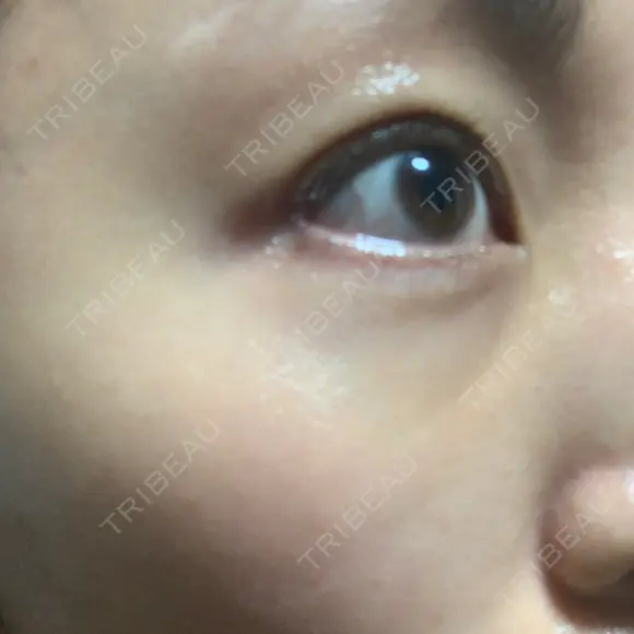 クマ治療 / 脂肪注入（肌） MIL CLINIC OSAKA DAY 19 メイン用